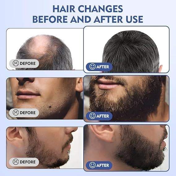 Derma Stamp 140A Micro Needling Tool For Hair, Skin And Acne - Khareedlo.com.pk