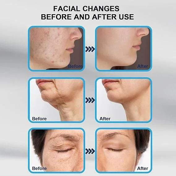 Derma Stamp 140A Micro Needling Tool For Hair, Skin And Acne - Khareedlo.com.pk