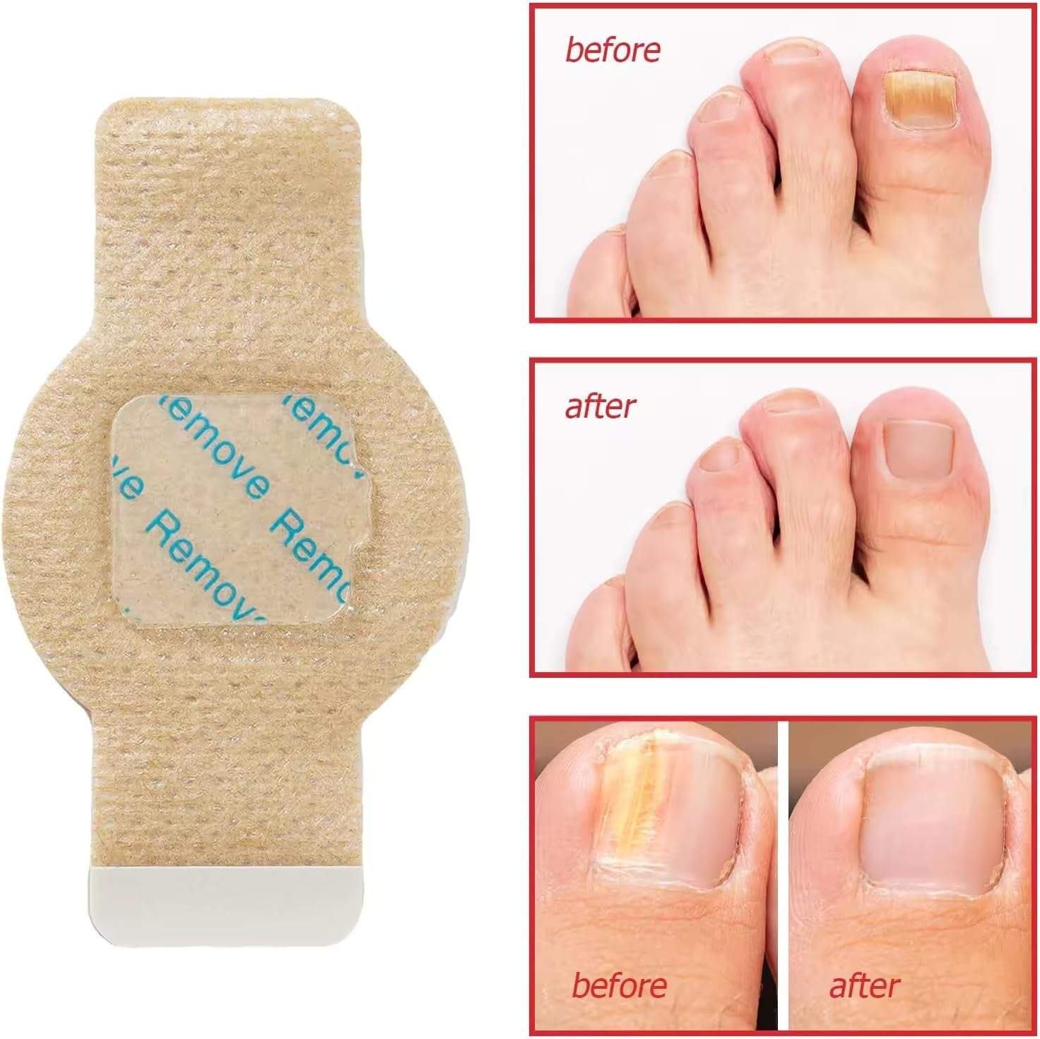 Night Time Renewal Fungal Nail Patches