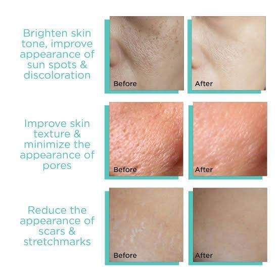 Derma Stamp 140A Micro Needling Tool For Hair, Skin And Acne - Khareedlo.com.pk