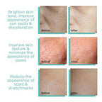 Derma Stamp 140A Micro Needling Tool For Hair, Skin And Acne - Khareedlo.com.pk