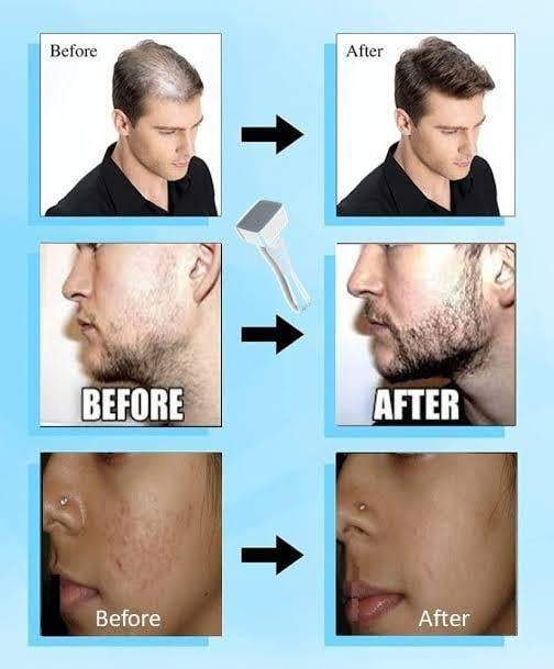 Derma Stamp 140A Micro Needling Tool For Hair, Skin And Acne - Khareedlo.com.pk