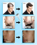 Derma Stamp 140A Micro Needling Tool For Hair, Skin And Acne - Khareedlo.com.pk